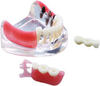 Teaching Model,Dental Implant and Restoration Model, Silicon Rubber Dental Teeth Model Inferior Removable Restoration Implant Bridge Demo Model for Teaching and Studying