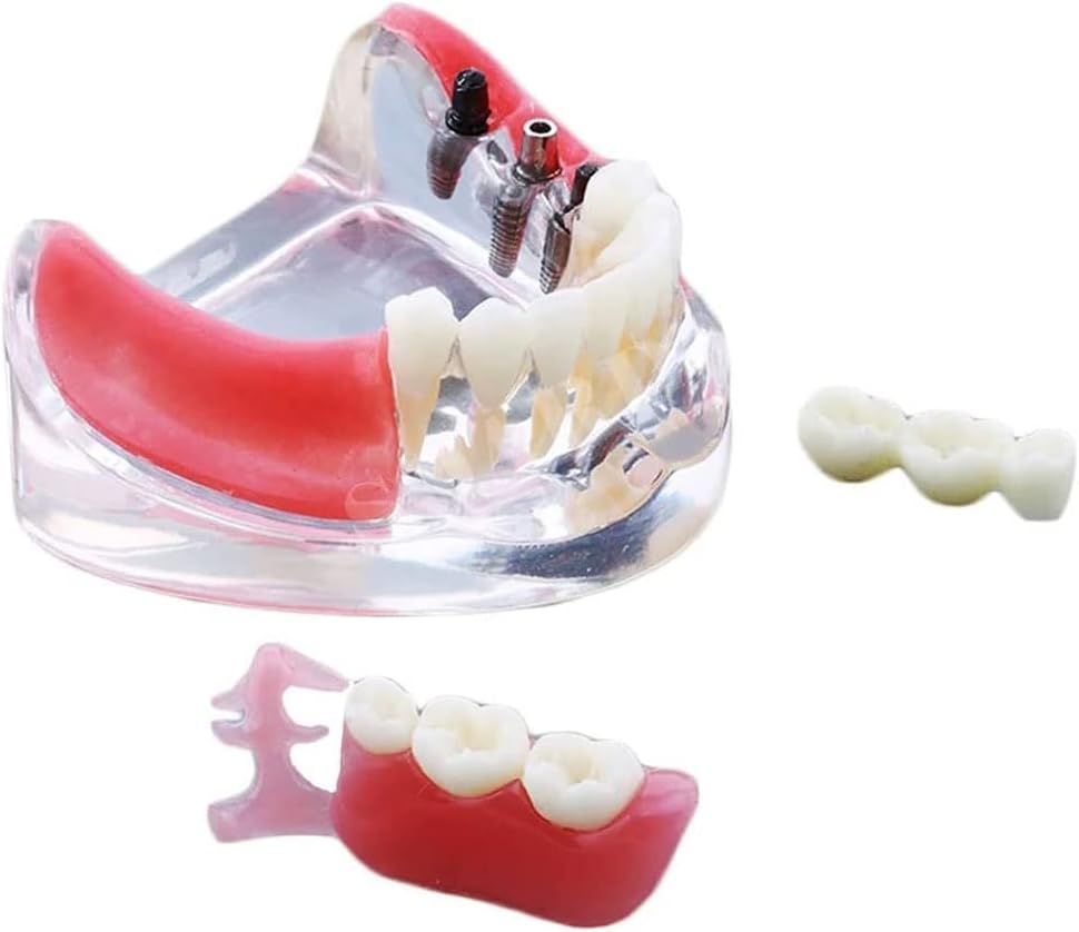 Teaching Model,Dental Implant and Restoration Model, Silicon Rubber Dental Teeth Model Inferior Removable Restoration Implant Bridge Demo Model for Teaching and Studying