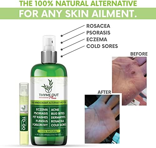 Thyme Out Plus Eczema Treatment, Psoriasis Treatment Treats Acne, Dermatitis, Rosacea, Cold Sores, Pet Rashes, Bug Bites, Poison Ivy, Anti Itch Spray for Itchy Skin Relief for Kids, Adult & Baby