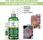 Thyme Out Plus Eczema Treatment, Psoriasis Treatment Treats Acne, Dermatitis, Rosacea, Cold Sores, Pet Rashes, Bug Bites, Poison Ivy, Anti Itch Spray for Itchy Skin Relief for Kids, Adult & Baby