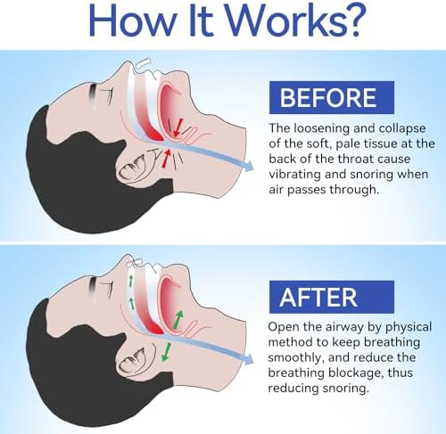 Anti Snoring Devices, Anngola Snoring Solution, Silicone Magnetic Anti Snoring Nose Clip, Effective Hale Breathing Aid, Stop Snoring to Restful Sleep(10 Pack)