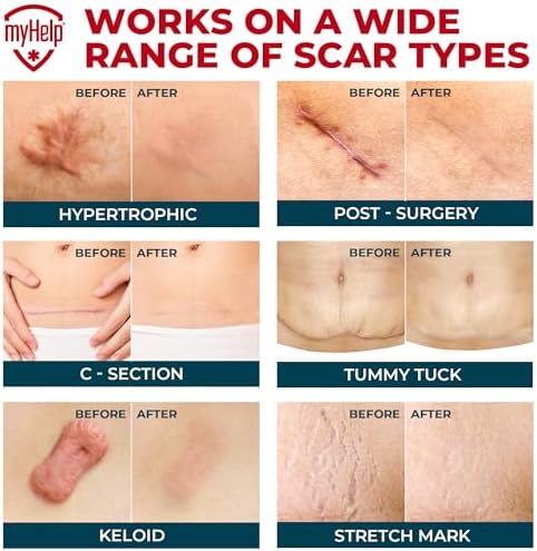 Medical Grade Silicone Scar Tape - 1.6”x150” - Visible Difference on Keloid & С-Section - Reusable Silicone Scar Sheets - Easy to Use