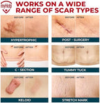 Medical Grade Silicone Scar Tape - 1.6”x150” - Visible Difference on Keloid & С-Section - Reusable Silicone Scar Sheets - Easy to Use