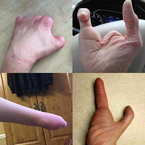active hands Limb Difference Aid – for Gripping in Gym/Home with Missing Fingers/Hand Parts