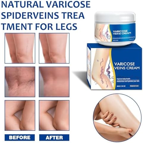 Varicose Veins Cream for Legs - Gentle with Natural Ingredients, Suitable for Most Skin Types 50G/1.76 OZ