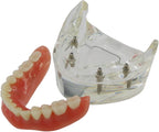 Dental Implant Teeth Demo Model Mandibular Overdenture with 4 Implants