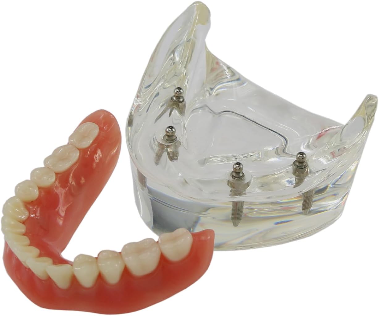 Dental Implant Teeth Demo Model Mandibular Overdenture with 4 Implants