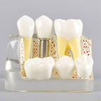 Standard Teeth Model, Dental Crown Models, 4 Times Magnification Demonstration Dental Implant Teeth Model for Doctor-Patient Communication Planting Explanation