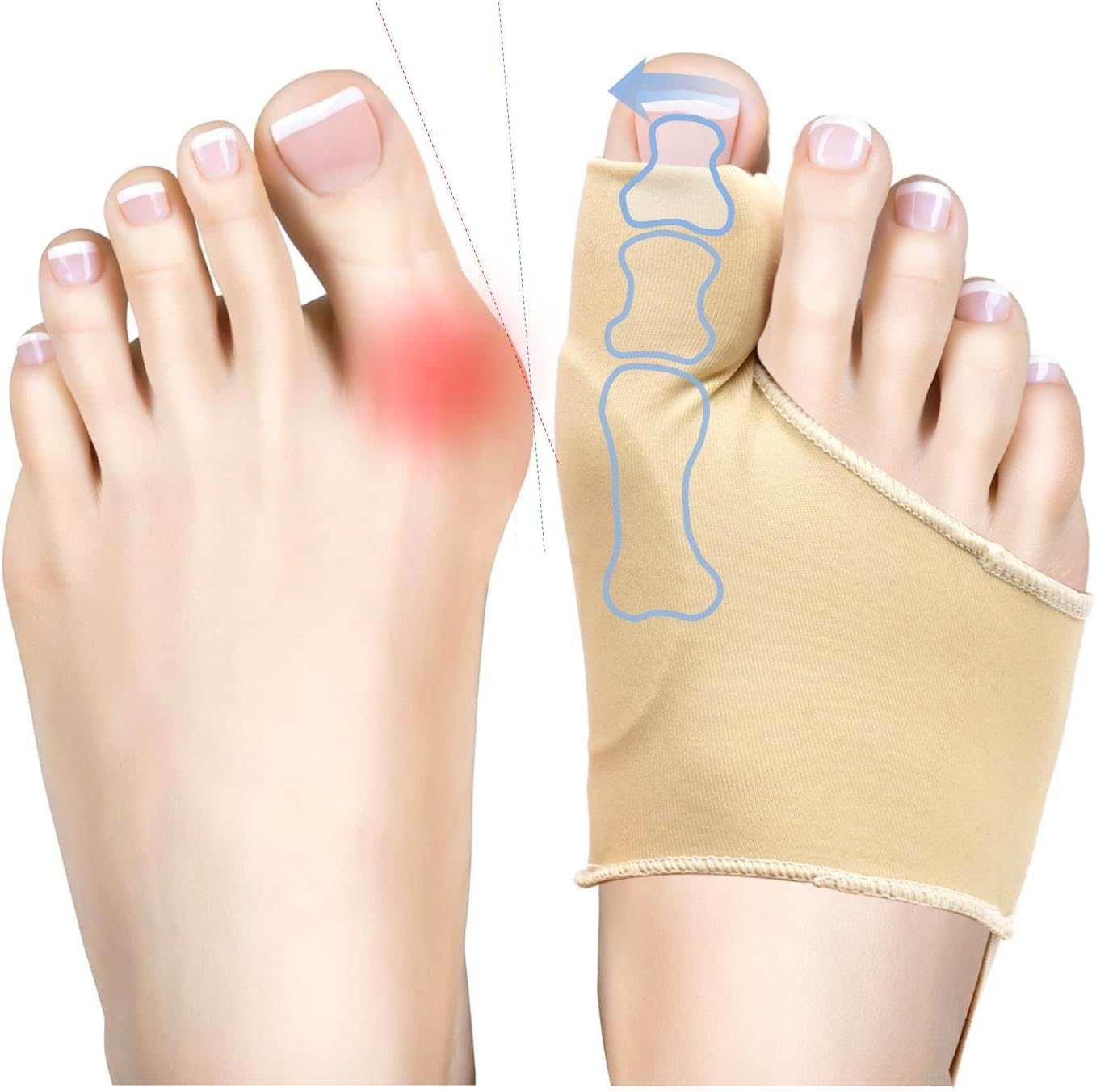 Bunion Corrector Sleeve, Orthopedic Toe Splint for Pain Relief, 2 Pack, Beige (2, Beige)