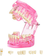 ZENFUN Disease Teeth Model with Dental Implant Bridge, Dental Model for Patient and Dental Student Education, Teeth Typodonts Analysis Demonstration Teeth Model Standard Size (Pink)