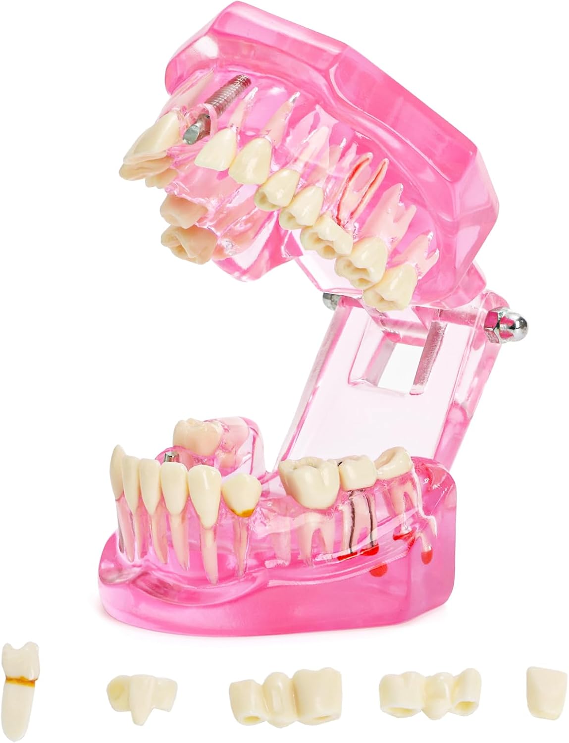 ZENFUN Disease Teeth Model with Dental Implant Bridge, Dental Model for Patient and Dental Student Education, Teeth Typodonts Analysis Demonstration Teeth Model Standard Size (Pink)