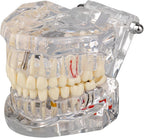 Ultrassist Transparent Dental Disease Teeth Model with Removable Teeth, Dental Pathology Demonstration Model for Dentist Patient Education & Teaching