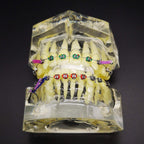 Dental Typodont with Metal Brackets Orthodontic Teeth Model with Ligature Tie