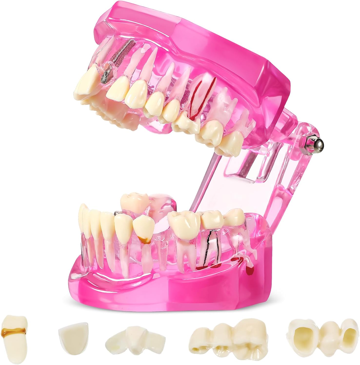 Outus Disease Teeth Model Dental Implant Teeth Model with Removable Tooth Dentist Standard Tooth Pathological Demonstration for Christmas Education Dental Supplies(Pink,1 Pcs)
