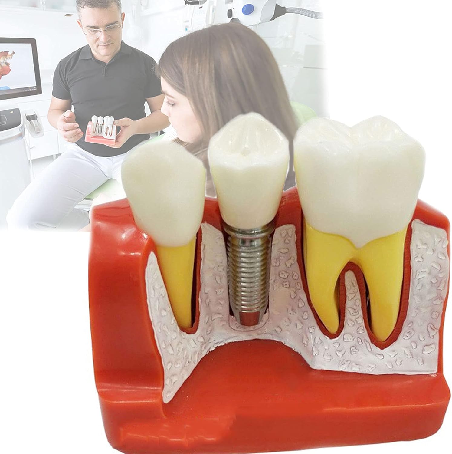 Standard Teeth Model, Dental Crown Models, 4 Times Magnification Demonstration Dental Implant Teeth Model for Doctor-Patient Communication Planting Explanation