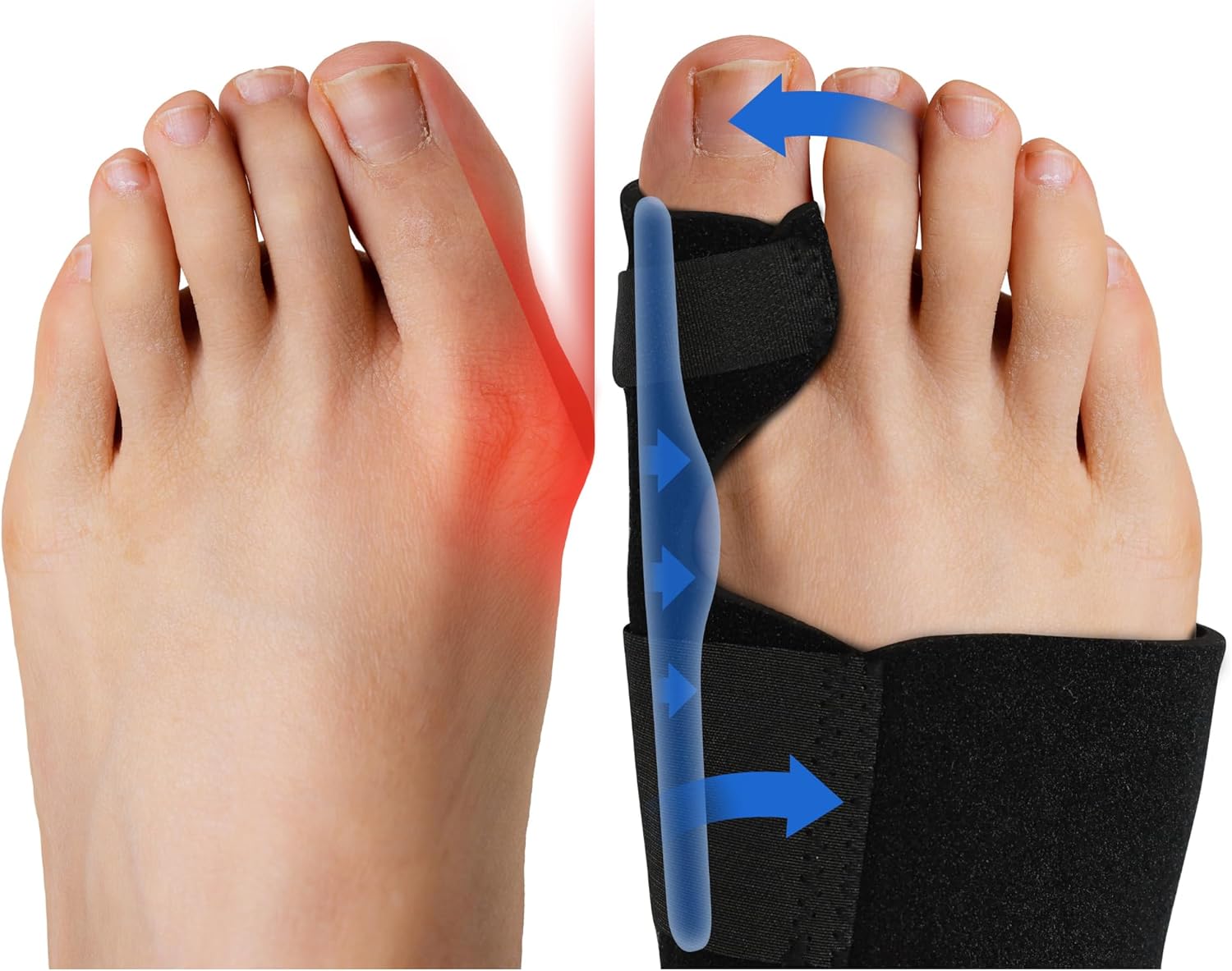 Fittest Pro Bunion Corrector (2pcs), Orthopedic Bunion Splint, Big Toe Separator Pain Relief, Non-Surgical Hallux Valgus Correction, Hammer Toe Straightener, Day Night Support
